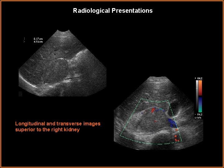 Radiological Presentations Longitudinal and transverse images superior to the right kidney 