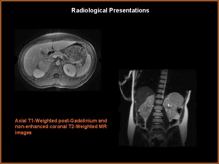 Radiological Presentations Axial T 1 -Weighted post-Gadolinium and non-enhanced coronal T 2 -Weighted MR Radiological Presentations Axial T 1 -Weighted post-Gadolinium and non-enhanced coronal T 2 -Weighted MR