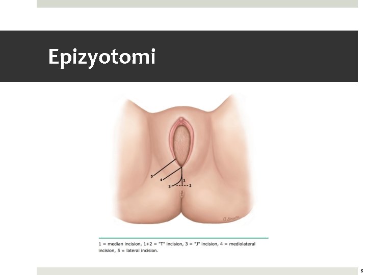 Epizyotomi 5 