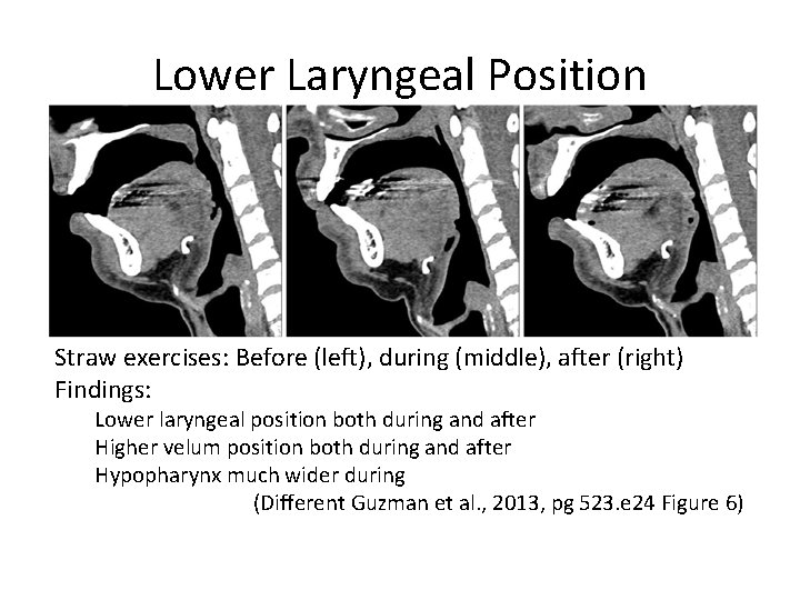 Lower Laryngeal Position Straw exercises: Before (left), during (middle), after (right) Findings: Lower laryngeal