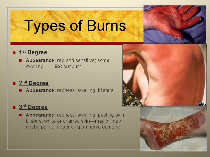 Types of Burns n 1 st Degree n n 2 nd Degree n n