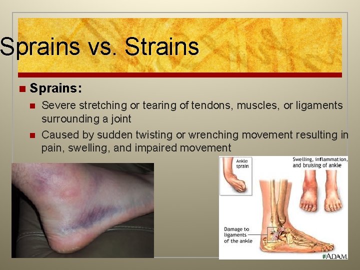 Sprains vs. Strains n Sprains: n n Severe stretching or tearing of tendons, muscles,