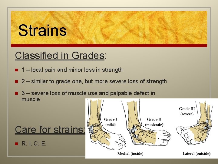 Strains Classified in Grades: n 1 – local pain and minor loss in strength