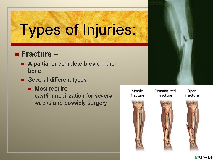 Types of Injuries: n Fracture – n n A partial or complete break in