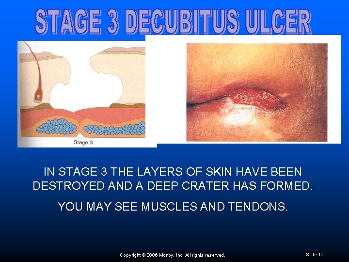 IN STAGE 3 THE LAYERS OF SKIN HAVE BEEN DESTROYED AND A DEEP CRATER