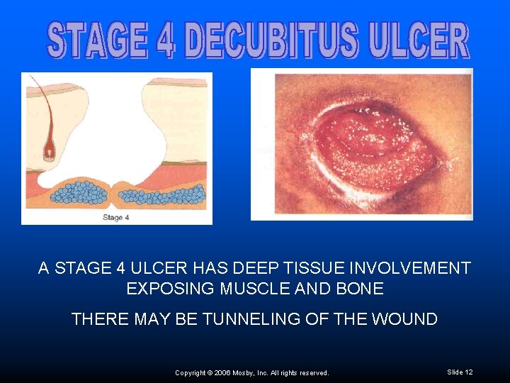 A STAGE 4 ULCER HAS DEEP TISSUE INVOLVEMENT EXPOSING MUSCLE AND BONE THERE MAY