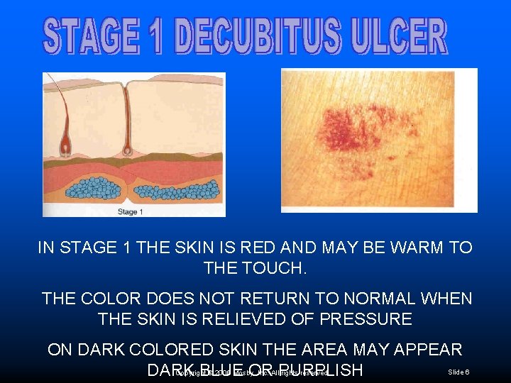 IN STAGE 1 THE SKIN IS RED AND MAY BE WARM TO THE TOUCH.