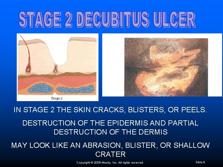 IN STAGE 2 THE SKIN CRACKS, BLISTERS, OR PEELS. DESTRUCTION OF THE EPIDERMIS AND