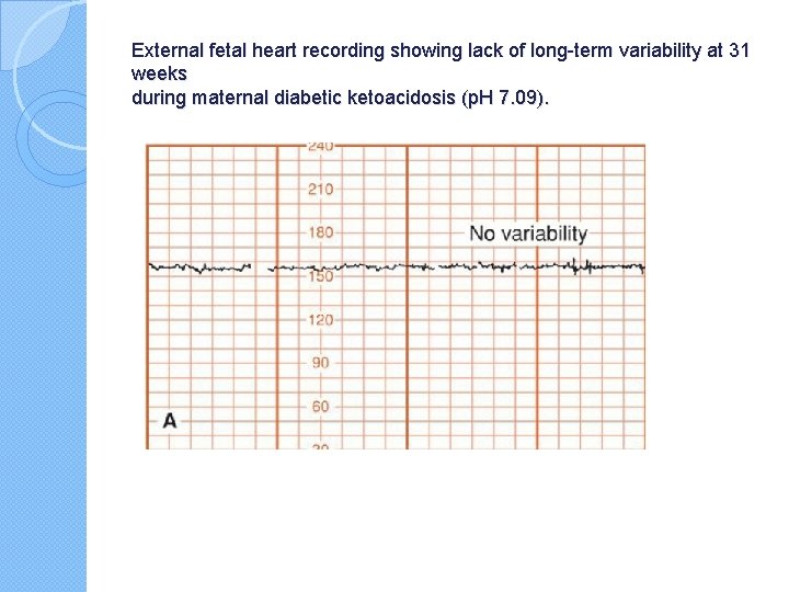 External fetal heart recording showing lack of long-term variability at 31 weeks during maternal