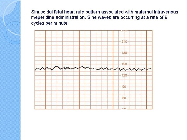 Sinusoidal fetal heart rate pattern associated with maternal intravenous meperidine administration. Sine waves are