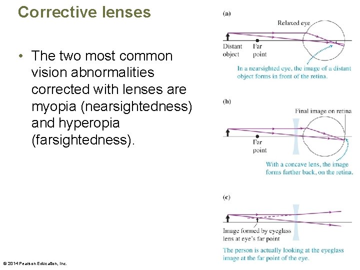 Corrective lenses • The two most common vision abnormalities corrected with lenses are myopia