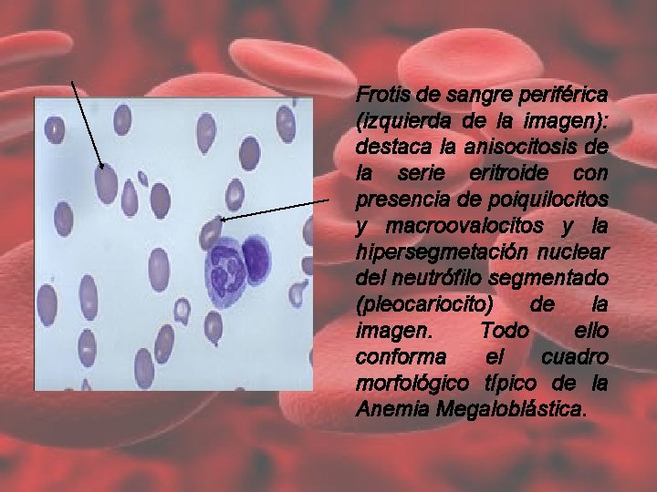 Frotis de sangre periférica (izquierda de la imagen): destaca la anisocitosis de la serie Frotis de sangre periférica (izquierda de la imagen): destaca la anisocitosis de la serie