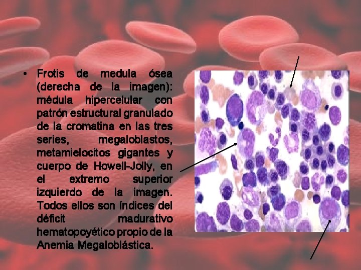 • Frotis de medula ósea (derecha de la imagen): médula hipercelular con patrón • Frotis de medula ósea (derecha de la imagen): médula hipercelular con patrón