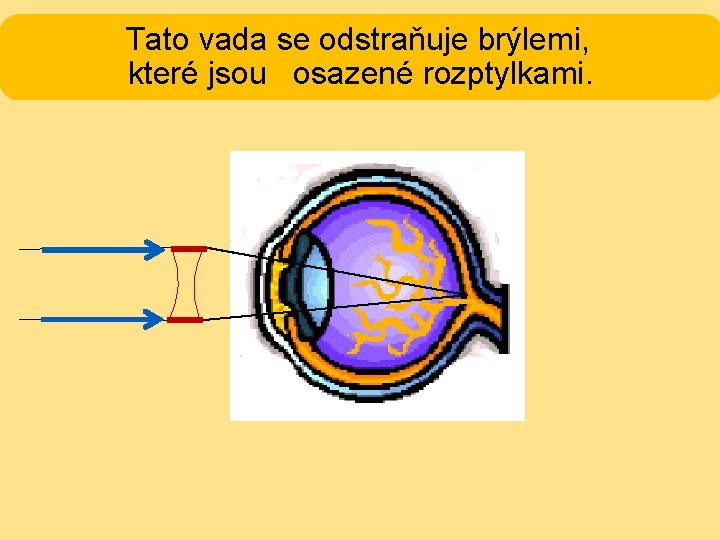 Tato vada se odstraňuje brýlemi, které jsou osazené rozptylkami. 