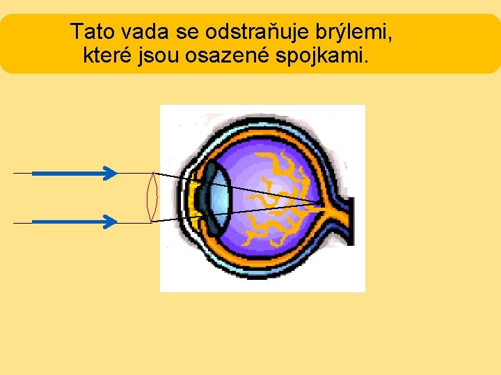 Tato vada se odstraňuje brýlemi, které jsou osazené spojkami. 