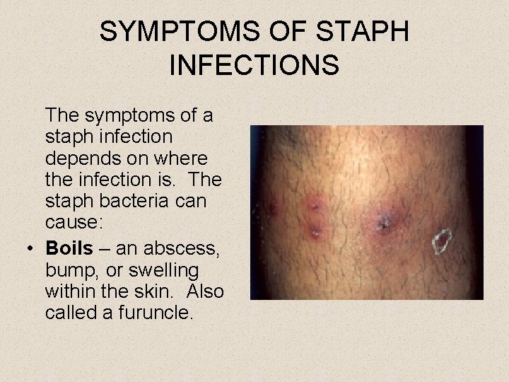 SYMPTOMS OF STAPH INFECTIONS The symptoms of a staph infection depends on where the