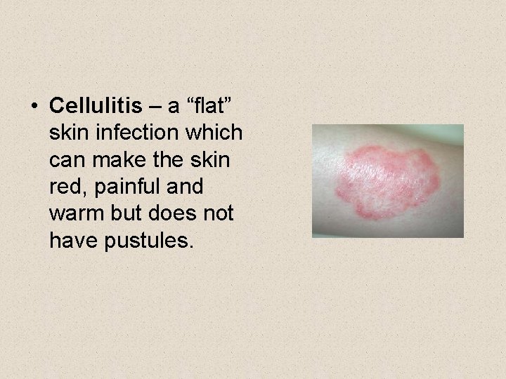  • Cellulitis – a “flat” skin infection which can make the skin red,