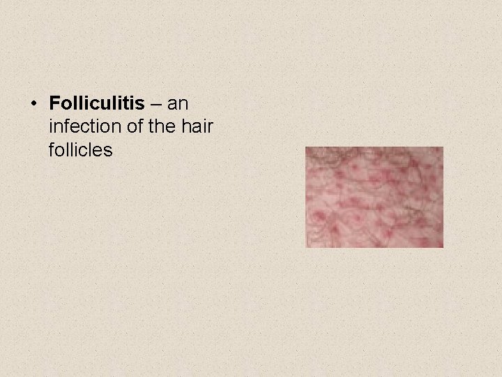  • Folliculitis – an infection of the hair follicles 