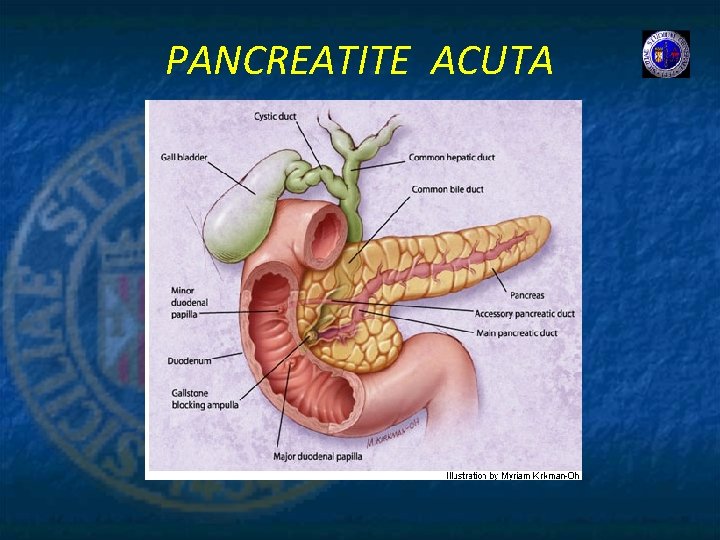 PANCREATITE ACUTA 