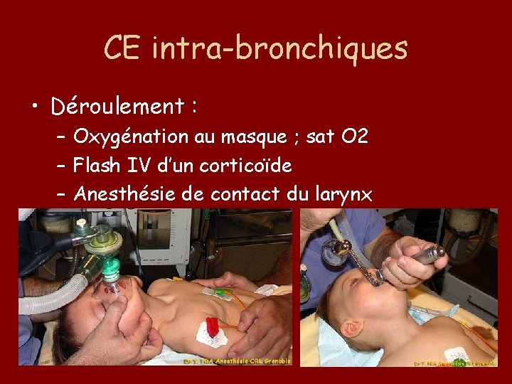 CE intra-bronchiques • Déroulement : – Oxygénation au masque ; sat O 2 –