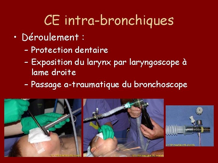 CE intra-bronchiques • Déroulement : – Protection dentaire – Exposition du larynx par laryngoscope