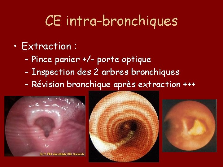 CE intra-bronchiques • Extraction : – Pince panier +/- porte optique – Inspection des