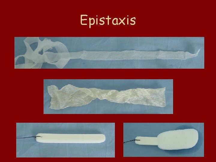 Epistaxis 