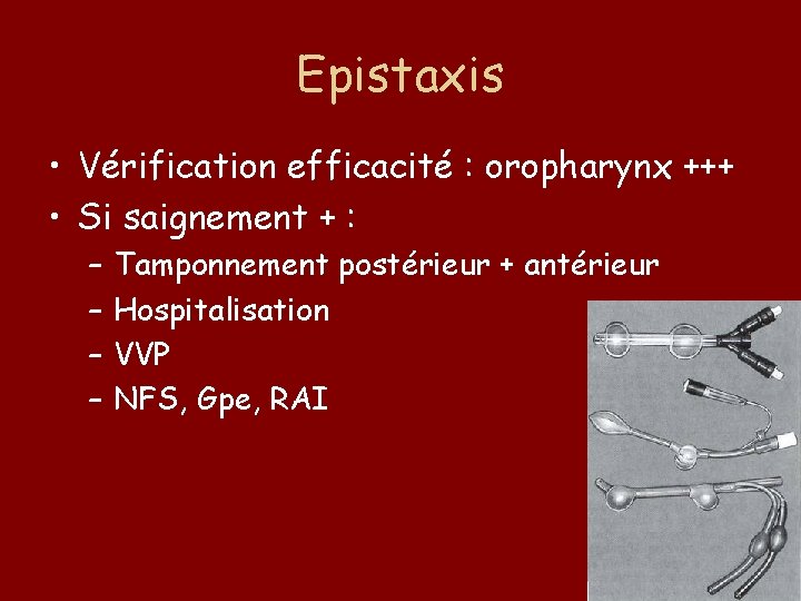 Epistaxis • Vérification efficacité : oropharynx +++ • Si saignement + : – –