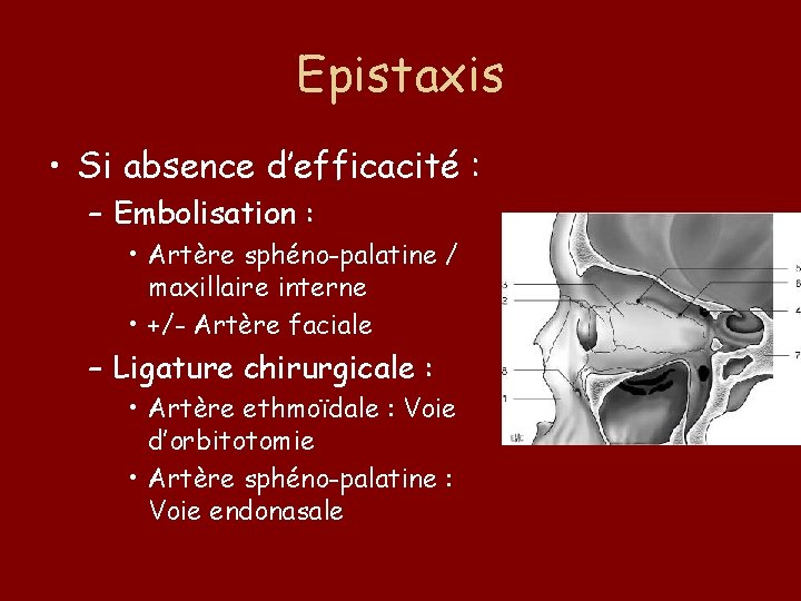 Epistaxis • Si absence d’efficacité : – Embolisation : • Artère sphéno-palatine / maxillaire