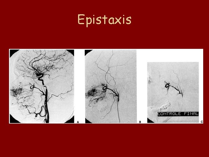 Epistaxis 