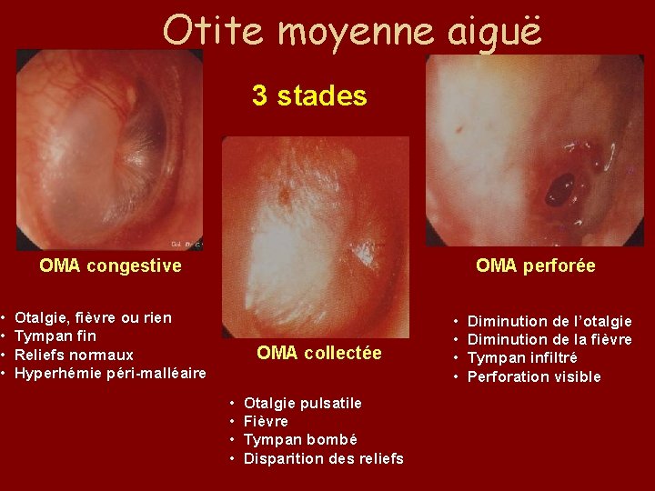  • • Otite moyenne aiguë 3 stades OMA congestive OMA perforée Otalgie, fièvre