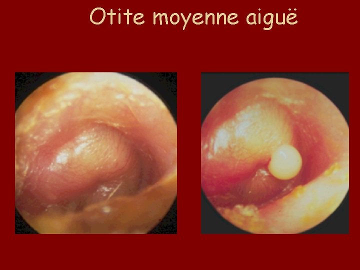 Otite moyenne aiguë 