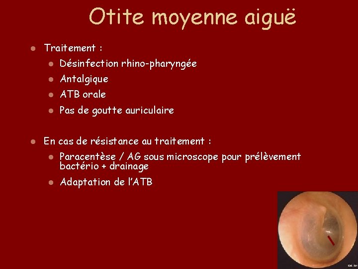 Otite moyenne aiguë l l Traitement : l Désinfection rhino-pharyngée l Antalgique l ATB