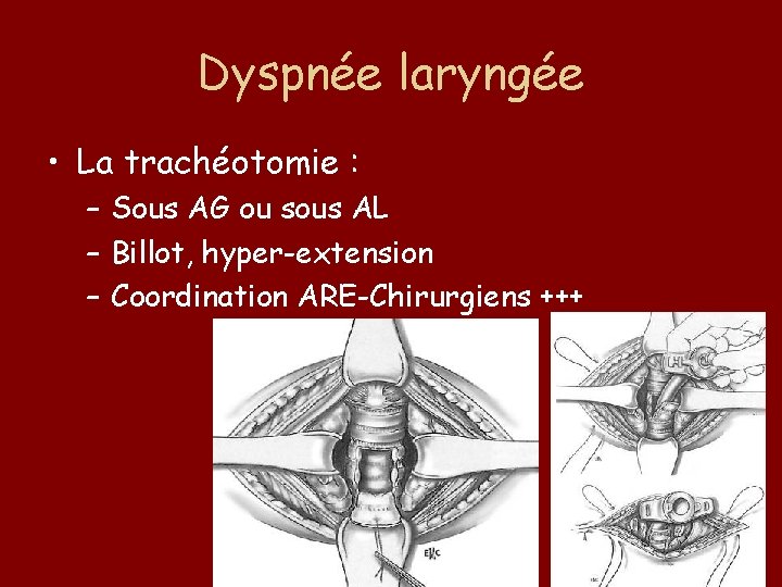 Dyspnée laryngée • La trachéotomie : – Sous AG ou sous AL – Billot,