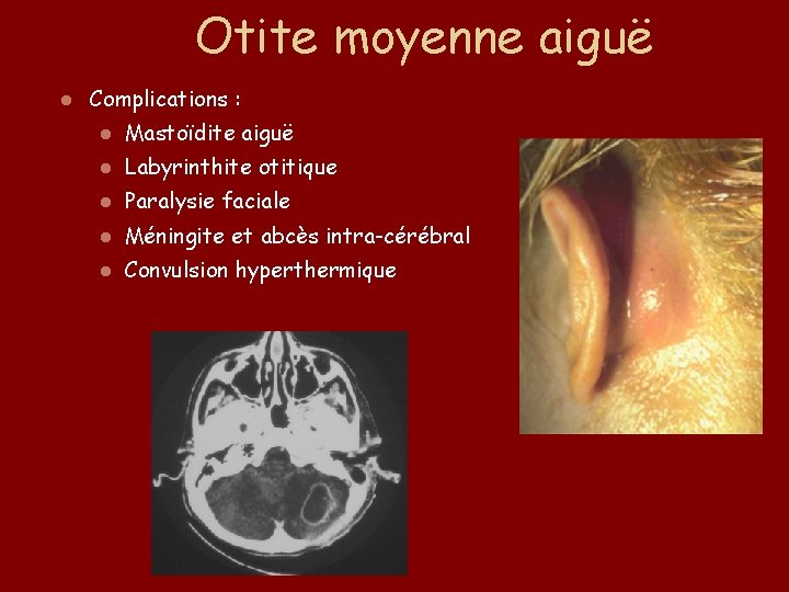 Otite moyenne aiguë l Complications : l Mastoïdite aiguë l Labyrinthite otitique l Paralysie