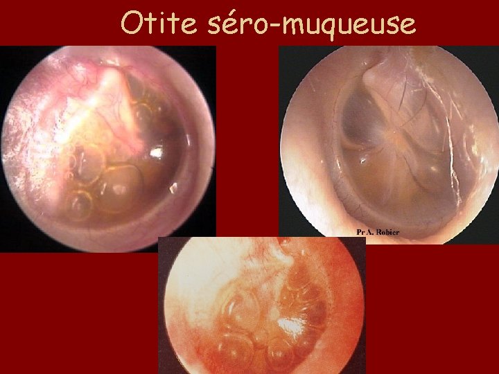 Otite séro-muqueuse 
