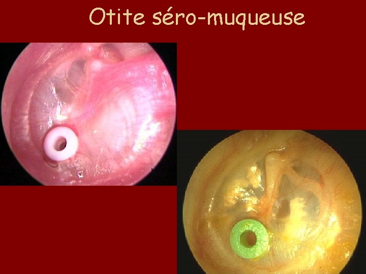 Otite séro-muqueuse 