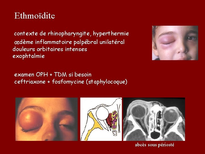  Ethmoïdite contexte de rhinopharyngite, hyperthermie œdème inflammatoire palpébral unilatéral douleurs orbitaires intenses exophtalmie
