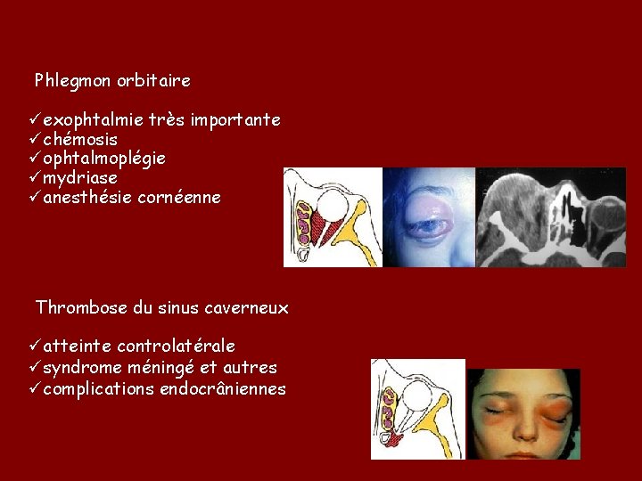  Phlegmon orbitaire üexophtalmie très importante üchémosis üophtalmoplégie ümydriase üanesthésie cornéenne Thrombose du sinus