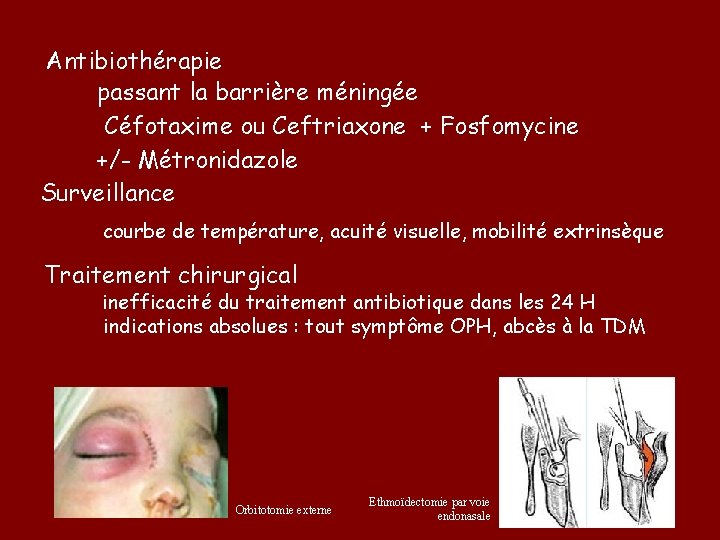  Antibiothérapie passant la barrière méningée Céfotaxime ou Ceftriaxone + Fosfomycine +/- Métronidazole Surveillance