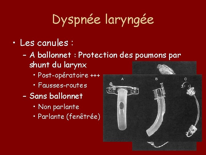 Dyspnée laryngée • Les canules : – A ballonnet : Protection des poumons par