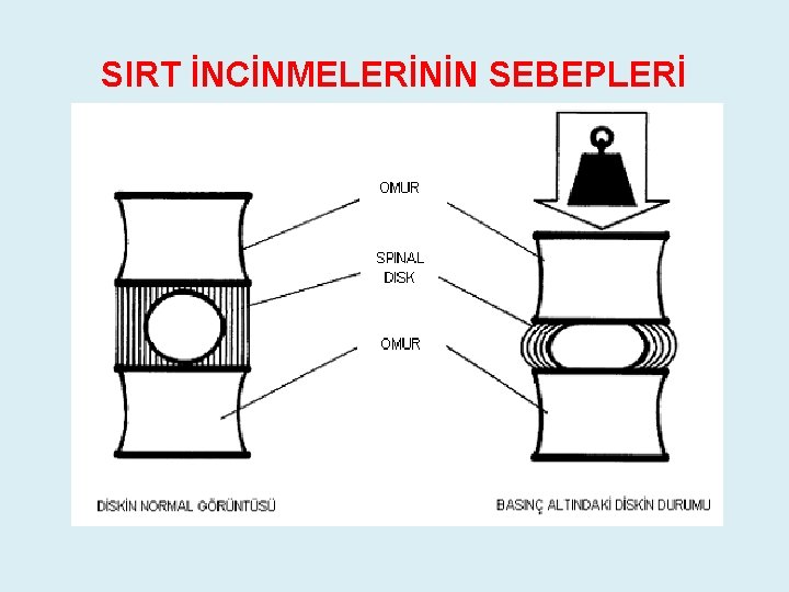 SIRT İNCİNMELERİNİN SEBEPLERİ SIRT İNCİNMELERİNİN SEBEPLERİ