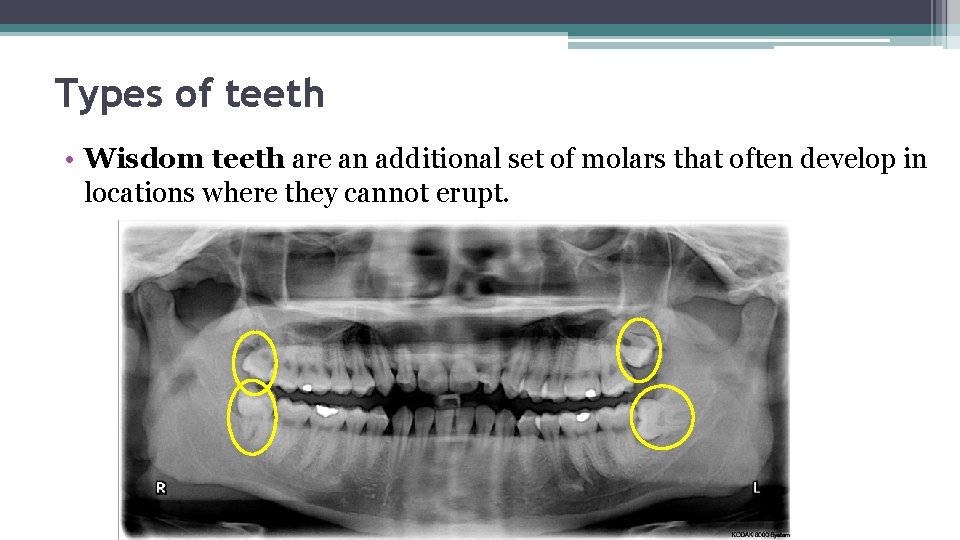 Types of teeth • Wisdom teeth are an additional set of molars that often