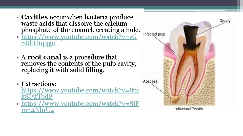  • Cavities occur when bacteria produce waste acids that dissolve the calcium phosphate