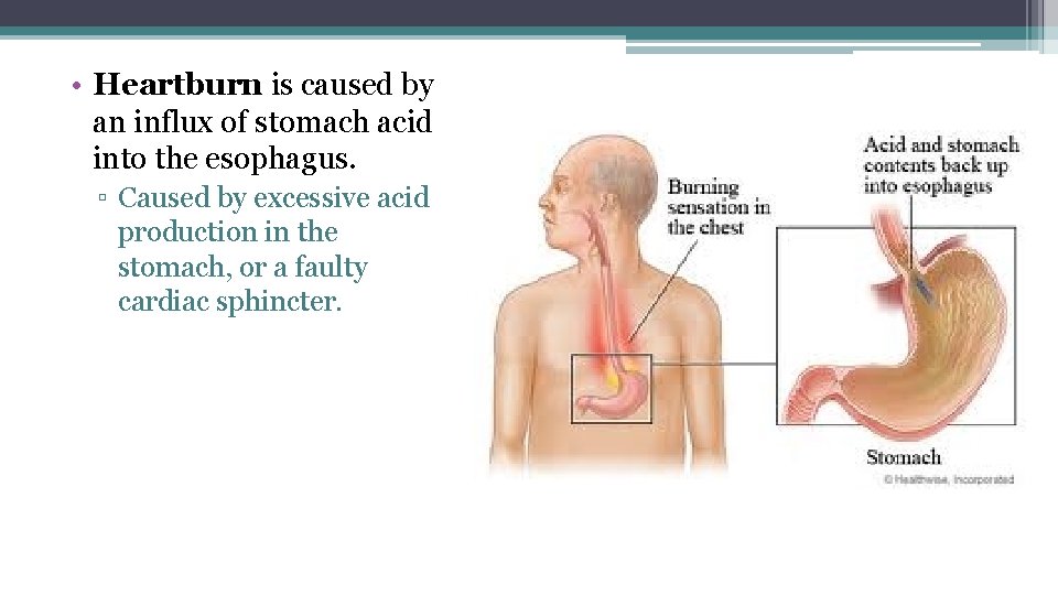  • Heartburn is caused by an influx of stomach acid into the esophagus.
