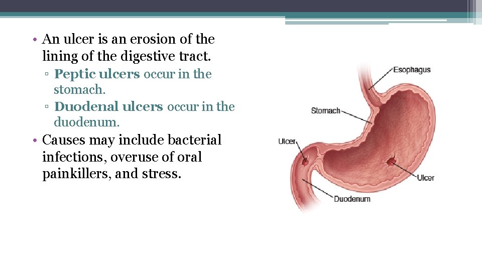  • An ulcer is an erosion of the lining of the digestive tract.