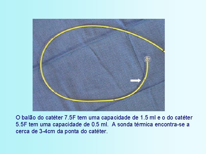 O balão do catéter 7. 5 F tem uma capacidade de 1. 5 ml