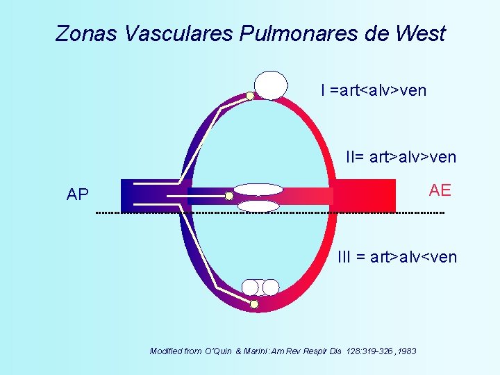 Zonas Vasculares Pulmonares de West I =art<alv>ven II= art>alv>ven AE AP III = art>alv<ven