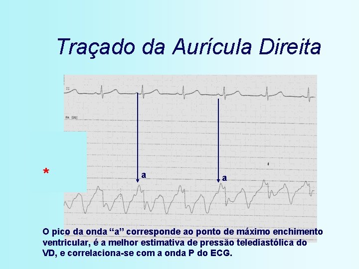 Traçado da Aurícula Direita * a a O pico da onda “a” corresponde ao