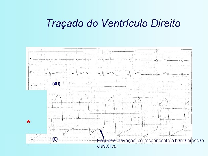 Traçado do Ventrículo Direito (40) * (0) Pequena elevação, correspondente à baixa pressão diastólica.